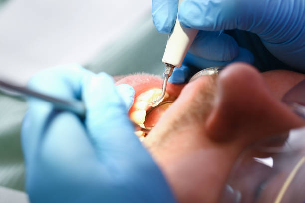 Best Emergency Dental Care for Broken or Chipped Teeth in Havana, IL